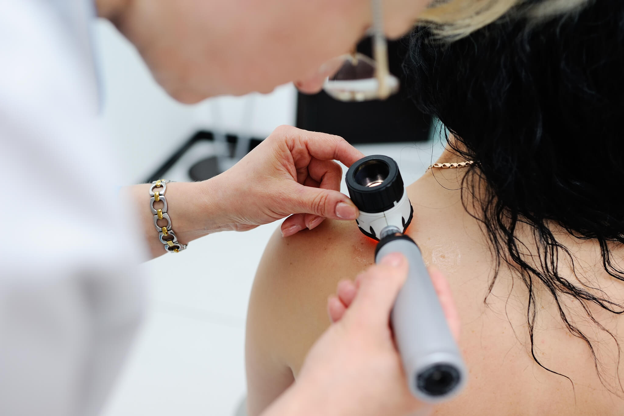 Removing Moles with Cosmetic Surgery